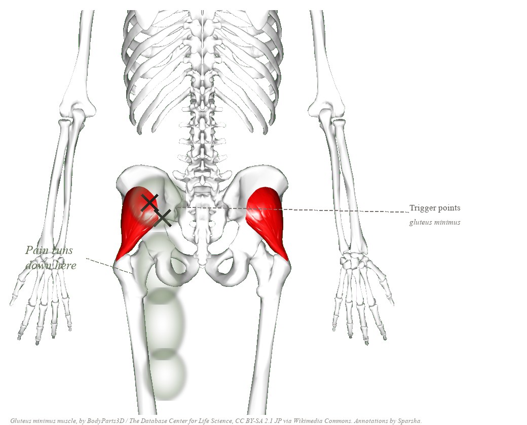 Posterior view of the pelvis and femurs with the gluteus minimus muscles highlighted in red on both sides, X marks on the left muscle, and sage clouds running down the leg showing the referred pain pattern.